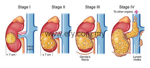 Kidney-Cancer-Stages1